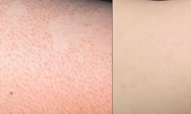 Piel con poros dilatados y vello, aspecto de "strawberry legs", comparada con piel lisa y clara.