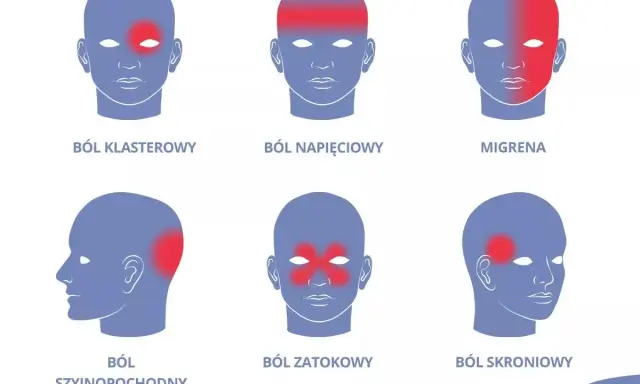 Ilustracja przedstawia sześć schematycznych głów z zaznaczonymi czerwonymi obszarami bólu: klasterowy, napięciowy, migrena, szyjnopochodny, zatokowy, skroniowy.