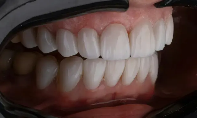 Piękne, zdrowe zęby po leczeniu periodontologicznym. Uśmiech pełen blasku i pewności siebie.