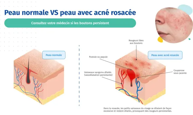 Comparaison peau normale et peau avec rosacée pustuleuse. L'image montre des pustules, rougeurs et vaisseaux dilatés caractéristiques de la rosacée.