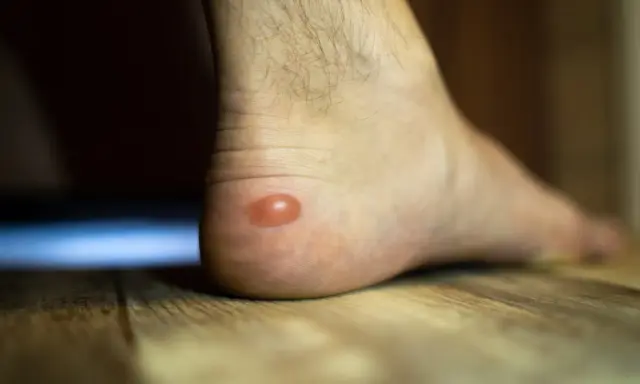Une phlyctène sur le talon, que faire ? Cette ampoule rouge sur la peau du pied est douloureuse.