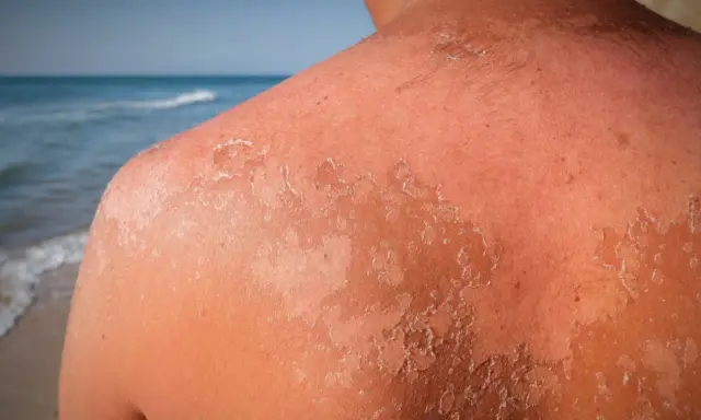 Peau qui pèle après un coup de soleil. La guérison peut prendre plusieurs jours, voire semaines.