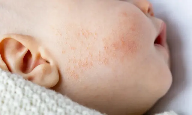 Gros plan sur la joue d'un bébé présentant des rougeurs et des petites plaques, signes d'eczéma bébé. La peau est irritée.