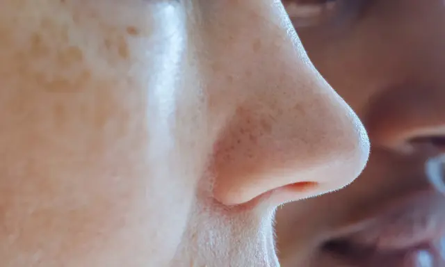 Gros plan sur un nez humain, montrant des pores dilatés et des filaments sébacés. Des taches de rousseur parsèment la peau.