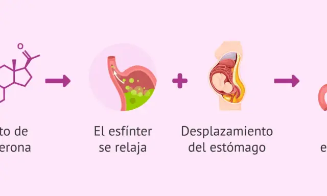 Aumento de progesterona y desplazamiento del estómago en el embarazo causan ardores estomacales.