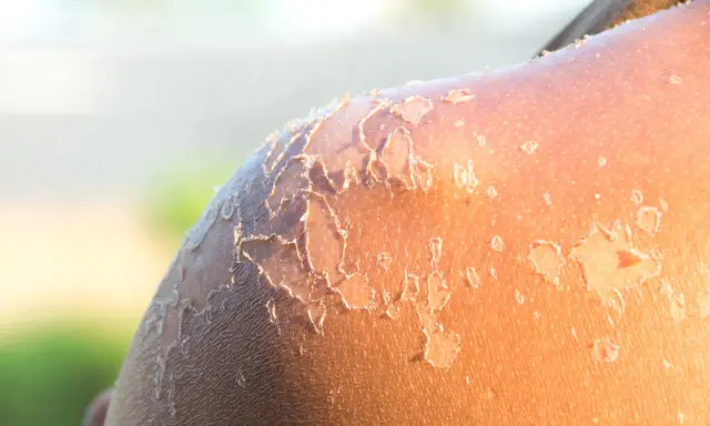 Peau qui pèle après un coup de soleil. La guérison peut prendre plusieurs jours, voire une semaine.