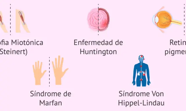 Ilustraciones de distrofia miotónica, Huntington, Marfan, Von Hippel-Lindau y retinosis pigmentaria, ejemplos de herencia autosomica dominante.