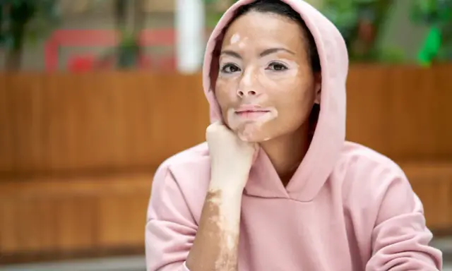 Jeune femme au visage et bras marqués par la dépigmentation de la peau, portant un sweat à capuche rose.