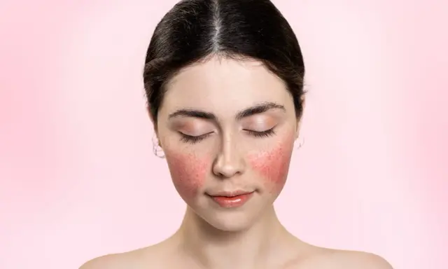 Visage d'une jeune femme aux joues marquées par une plaque rouge, les yeux fermés, sur fond rose doux.