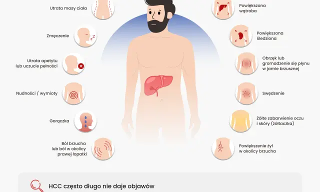 Ilustracja przedstawia sylwetkę mężczyzny z zaznaczonymi objawami nowotworu wątroby.