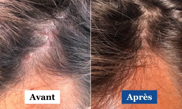Comparaison avant/après d'un cuir chevelu atteint de psoriasis et dermite séborrhéique. La partie gauche montre des plaques rouges et squameuses, la droite une peau apaisée.