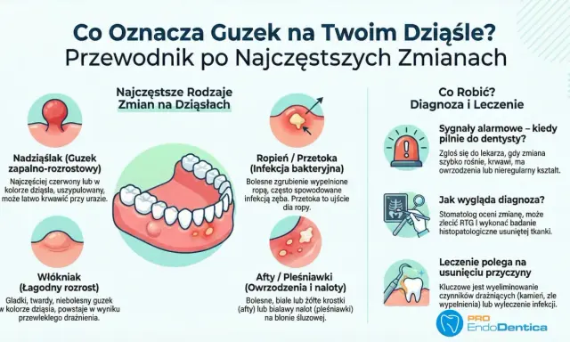 Ilustracja przedstawia ropień, czyli przetokę na dziąśle, jako bolesne zgrubienie z ropą, często spowodowane infekcją zęba.