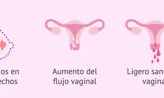 Cambios en pechos, aumento de flujo vaginal y ligero sangrado vaginal. Posible retraso menstrual.