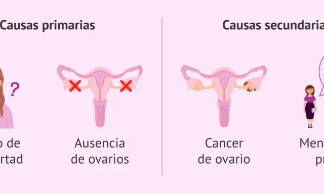 Ilustración explica que se puede tener la regla sin sangrar, mostrando causas primarias (retraso pubertad, ausencia ovarios) y secundarias (cáncer ovario, menopausia precoz).