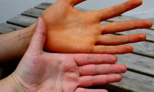 Zwei Hände im Vergleich: Eine ist orange gefärbt, was auf die carotin wirkung hindeutet. Die andere Hand hat eine normale Hautfarbe.
