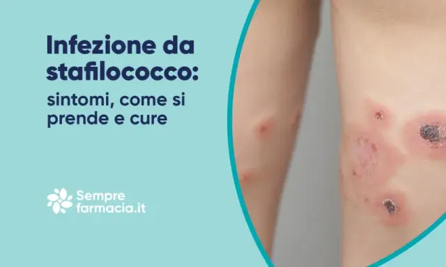 Infezione da stafilococco: cos'è, sintomi, come si prende e cure. Lesioni cutanee infette.