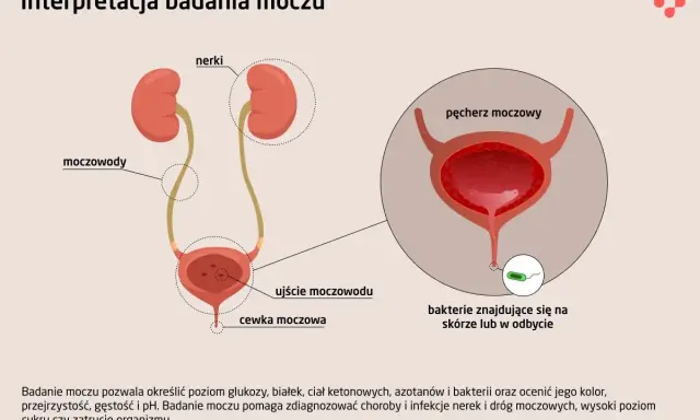 Ilustracja układu moczowego z zaznaczonymi nerkami, moczowodami i pęcherzem. Widoczne bakterie pałeczki w moczu, mogące świadczyć o infekcji.