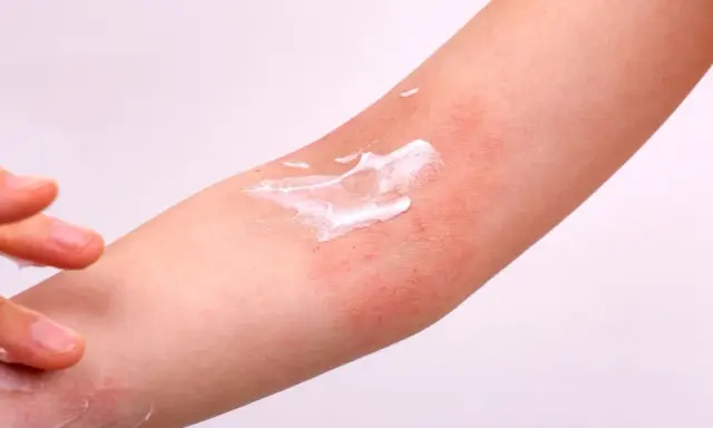 Application de crème sur une plaque sèche et rouge sur le bras, soulageant l'irritation cutanée.