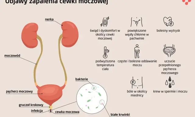 Zaczerwieniona cewka moczowa, objawy zapalenia: ból, pieczenie, częste oddawanie moczu, gorączka, obecność bakterii i białych krwinek.