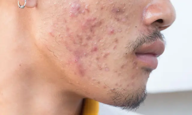 Gros plan sur le visage d'un homme présentant une acné sévère, avec des rougeurs et des pustules visibles sur la joue et le menton.