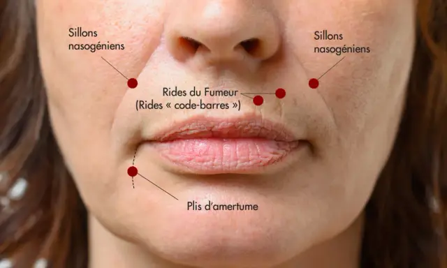 Gros plan sur le bas du visage d'une femme, montrant les sillons nasogéniens, les rides du fumeur et les plis d'amertume.