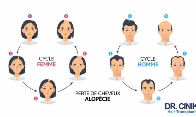 Illustration du cycle de perte de cheveux chez l'homme et la femme, montrant l'impact de la dht hormone sur l'alopécie.