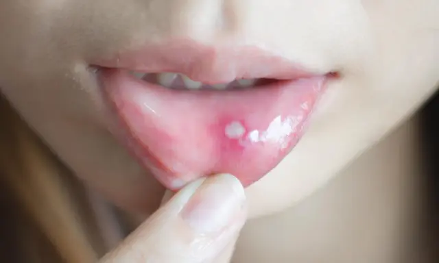 Dito un'afta, una piccola lesione dolorosa sulla mucosa orale, che può essere confusa con un tumore.