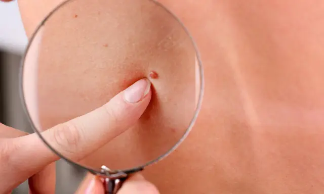 Un doigt pointe un grain de beauté qui saigne, observé à travers une loupe sur une peau claire.