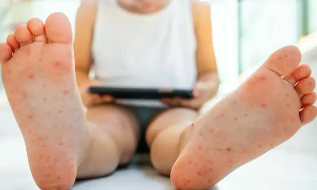 Małe czerwone kropki na stopach dziecka, które mogą wskazywać na wysypkę. Dziecko siedzi, trzymając tablet.