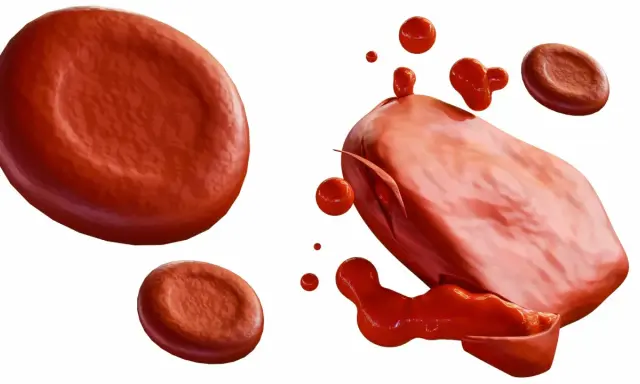 Rozpad czerwonych krwinek, czyli hemoliza. Co to jest? Obraz pokazuje uszkodzone erytrocyty i wypływającą z nich hemoglobinę.