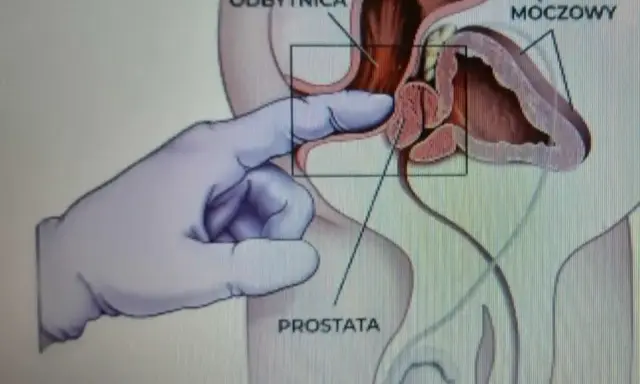 Ilustracja medyczna pokazująca palec w rękawiczce wykonujący masaż prostaty przez odbytnicę.