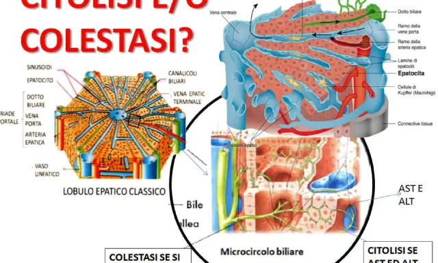 Diagrammi illustrano lobulo epatico e acino epatico, con focus su citolisi e colestasi, evidenziando epatociti e microcircolo biliare.