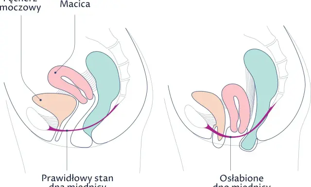 Ilustracja porównuje prawidłowy i osłabiony stan dna miednicy. Wypadająca macica objawy mogą być widoczne przy osłabieniu mięśni.