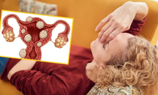 Ilustracja macicy z mięśniakami i kobieta z ręką na czole.