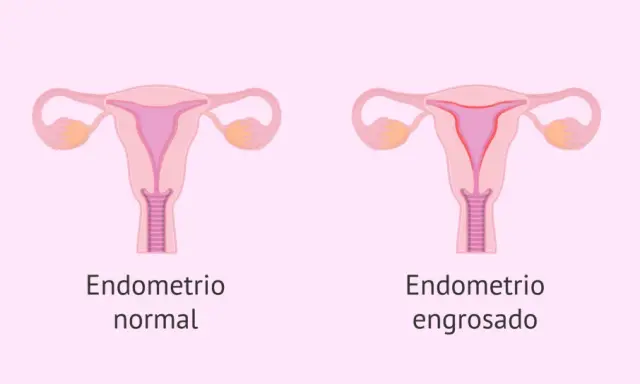Comparación visual de un útero con endometrio normal y otro con endometrio engrosado, indicativo de hiperplasia endometrial.