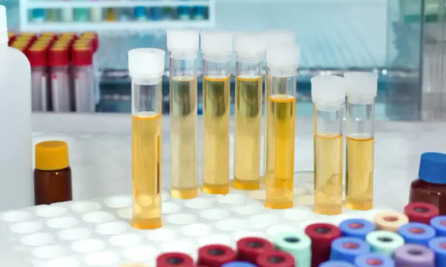 W probówkach laboratoryjnych widać żółtawy płyn, który może wskazywać na mętny mocz.