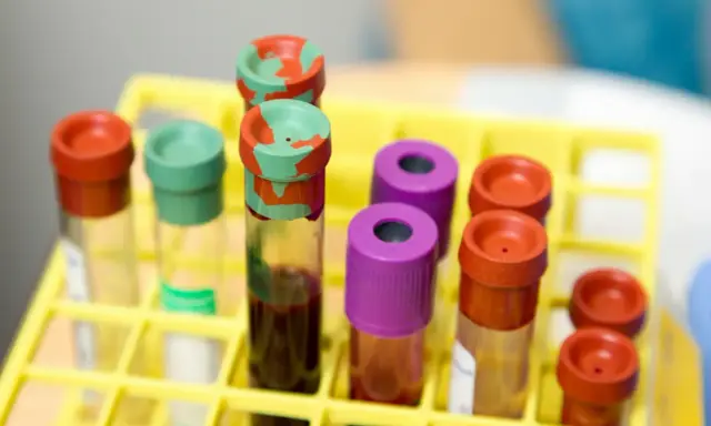 Probówki z krwią w żółtym stojaku laboratoryjnym.