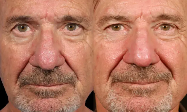 Gros plan sur le visage d'un homme, montrant les effets de la rosacée phymateuse sur son nez et ses joues.