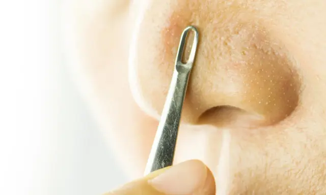 Un outil métallique est utilisé pour extraire un comédon fermé sur le nez.