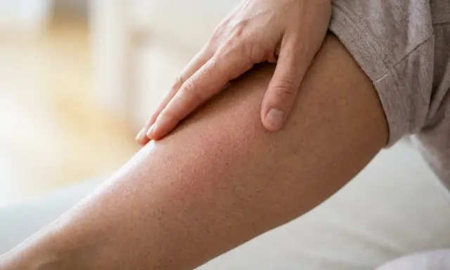 Eine Hand streicht über ein Bein mit geröteter, schuppiger Haut. Das Jucken der beine beim laufen ist deutlich zu spüren.
