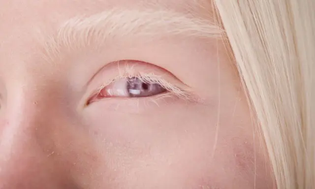 Blond włosy i jasne brwi otaczają fioletowe oczy, świadczące o albinizmie.