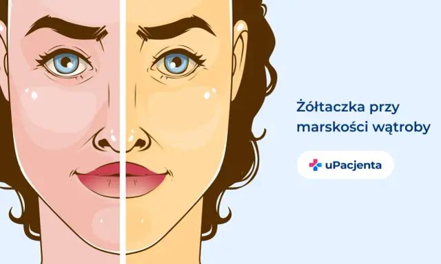 Żółtaczka przy marskości wątroby, jeden z objawów alkoholowego zapalenia wątroby, powoduje zażółcenie skóry.