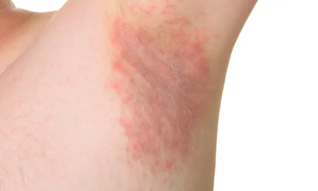 Irritazione cutanea sotto le ascelle, con chiazze rosse e sensazione di prurito sotto le ascelle senza rossore visibile.