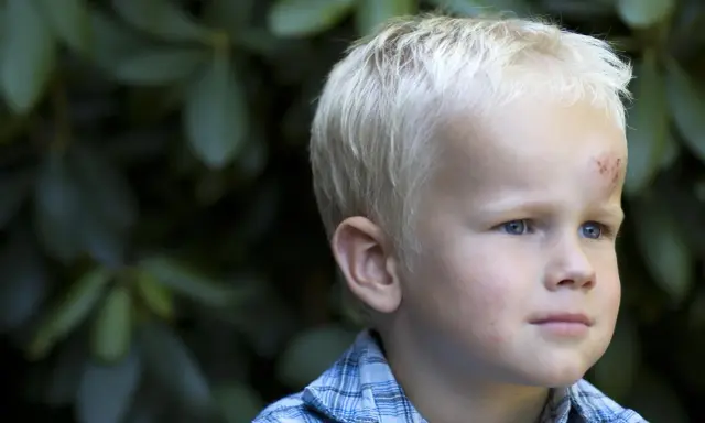 Chłopiec z jasnymi włosami ma na czole widoczny uraz głowy, zaczerwienienie i otarcie.