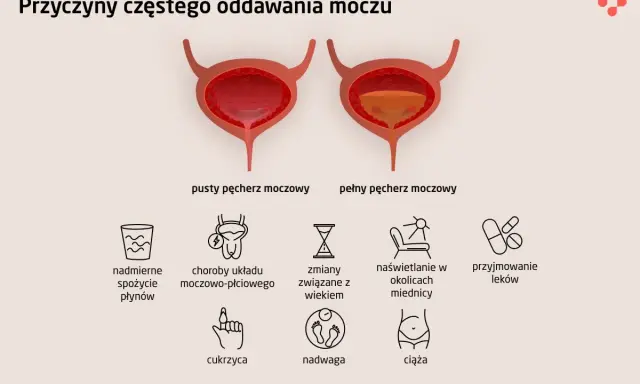 Ilustracja pokazuje pęcherz pusty i pełny, wyjaśniając przyczyny częstego sikania bez sikania.