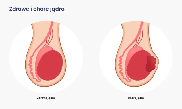 Ilustracja porównuje zdrowe jądro z chorym, na którym widoczny jest guz, wskazujący na raka moszny.
