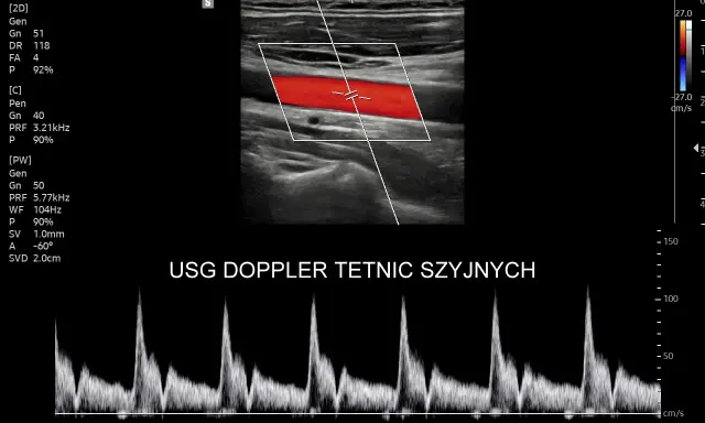 Obraz przedstawia badanie USG doppler tętnic szyjnych z widocznym przepływem krwi w czerwonych i niebieskich barwach oraz wykresem prędkości.