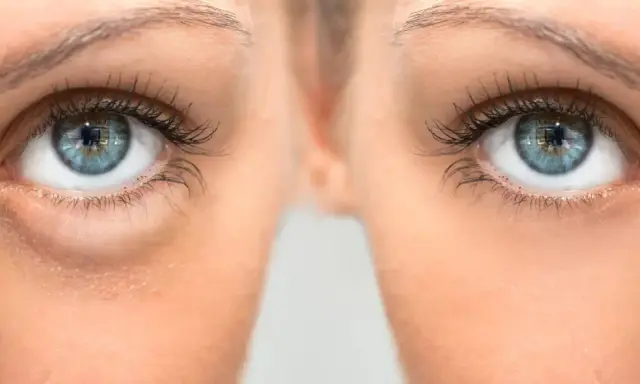 Gros plan sur des yeux bleus, montrant des poches sous les yeux. Le bicarbonate de soude est une astuce maison pour les atténuer.