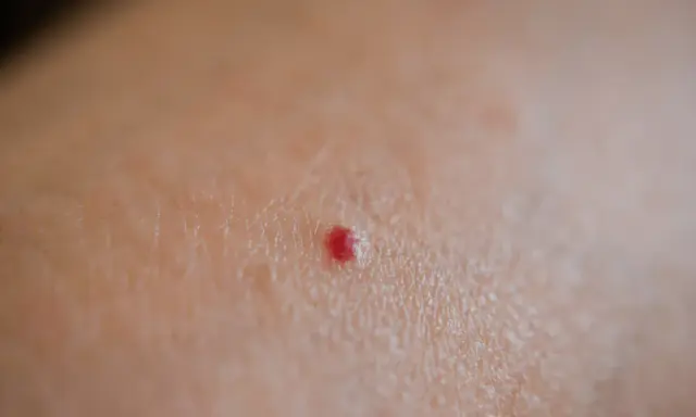 Una piccola macchia rossa sulla pelle, un neo rubino, senza alcun prurito.