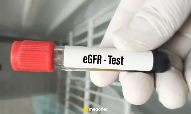 Rękawiczka trzyma probówkę z oznaczeniem "eGFR - Test". To ważny element badania gfr, oceniającego pracę nerek.